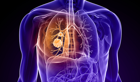 Lung Cancers